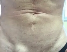 Mužský břišní stěna s viditelnou kýlovým výčnělkem.