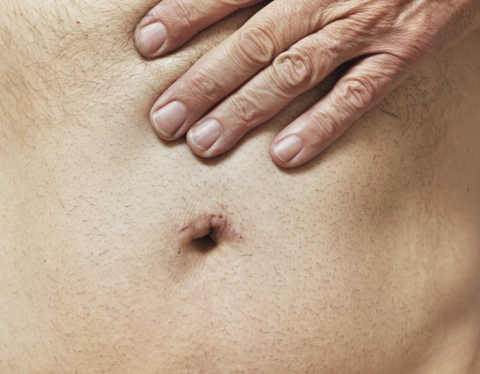 Human abdomen with hand on scar
